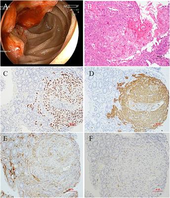 Case report: Advanced primary squamous cell carcinoma in the periampullary area with upregulation of programmed cell death-ligand 1 expression and response to sintilimab immunotherapy